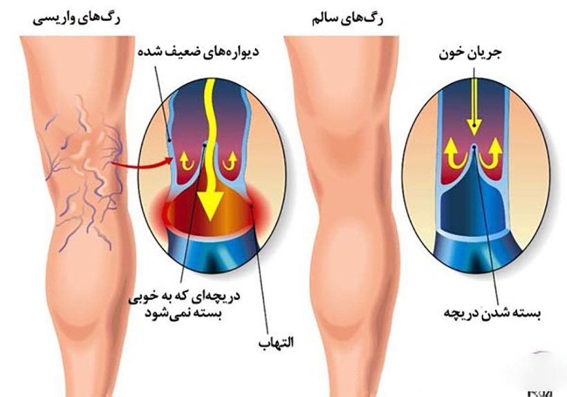 رگهای واریسی